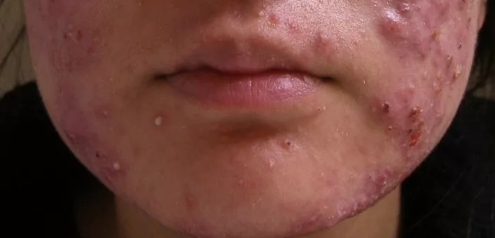 Gənə Xəstəliyi - Demodeks | Dermatoloq Hekim