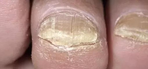 Dermatoloq Fəridə Axundova - Dırnaq xəstəlikləri haqqında
