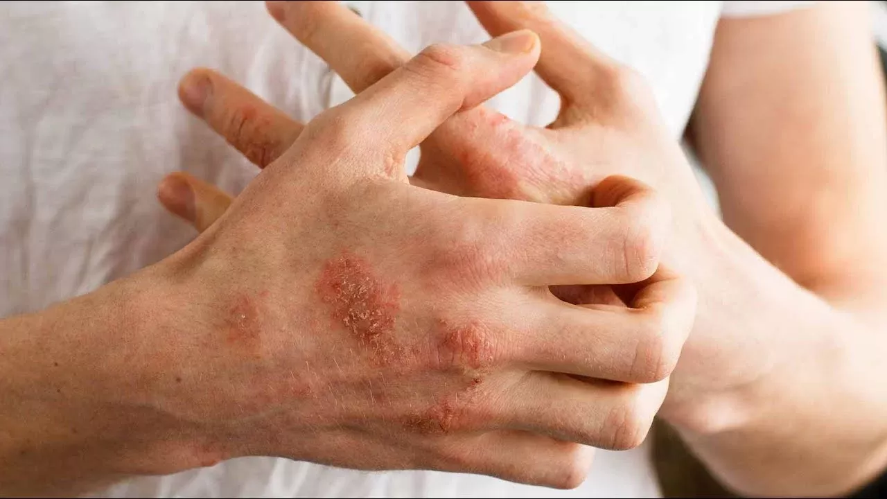Dermatoloq - Deri Hekimi - Ekzema