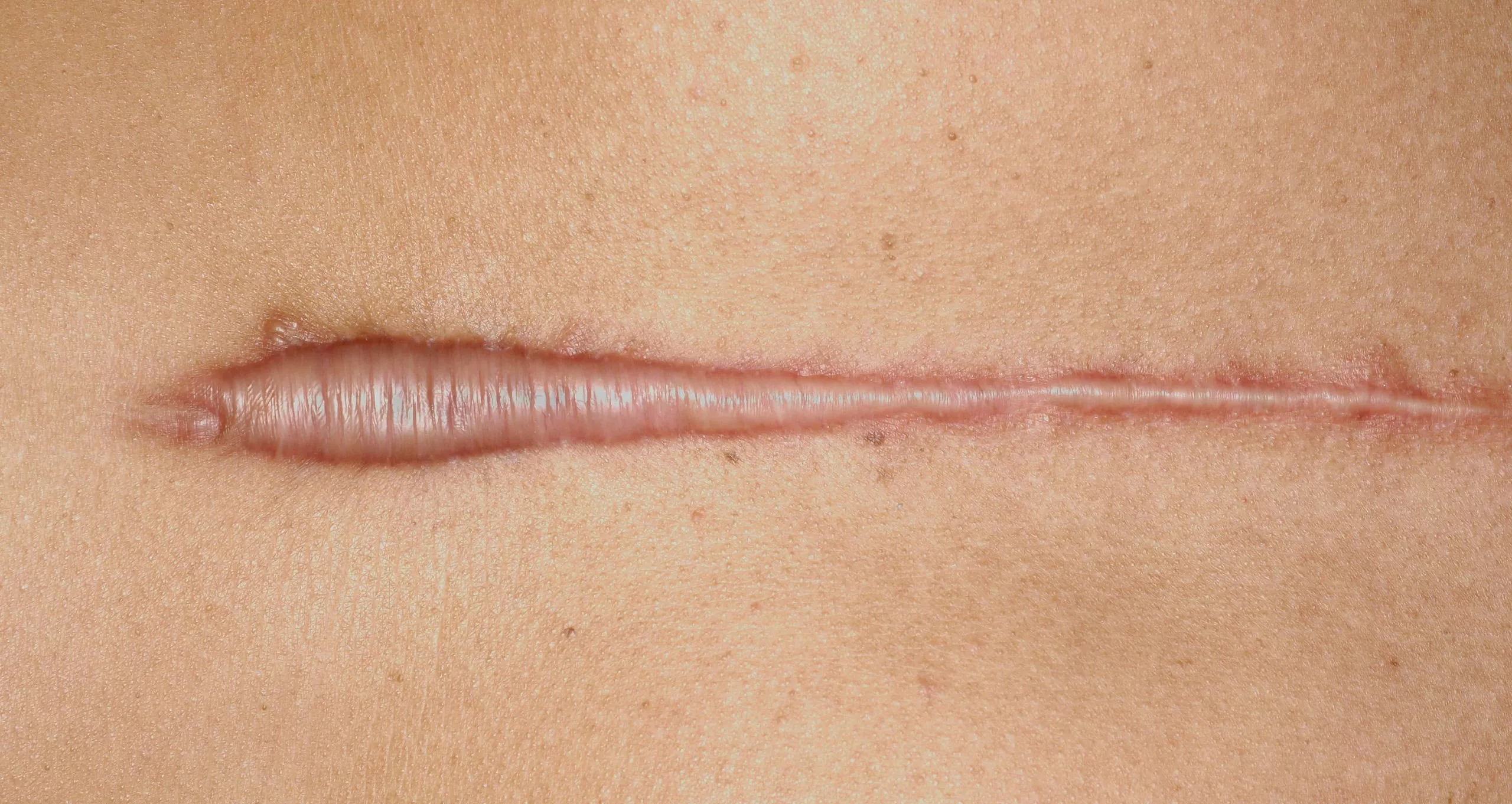 Keloid nə zaman yaranır? Keloid necə müalicə olunur?