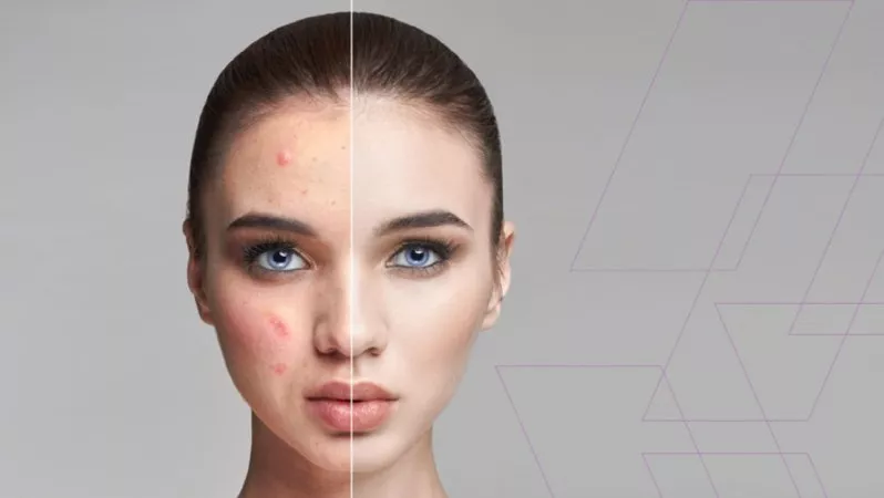 DERMATOLOQ - DƏRİ HƏKİMİ - SIZANAQ - LƏKƏ