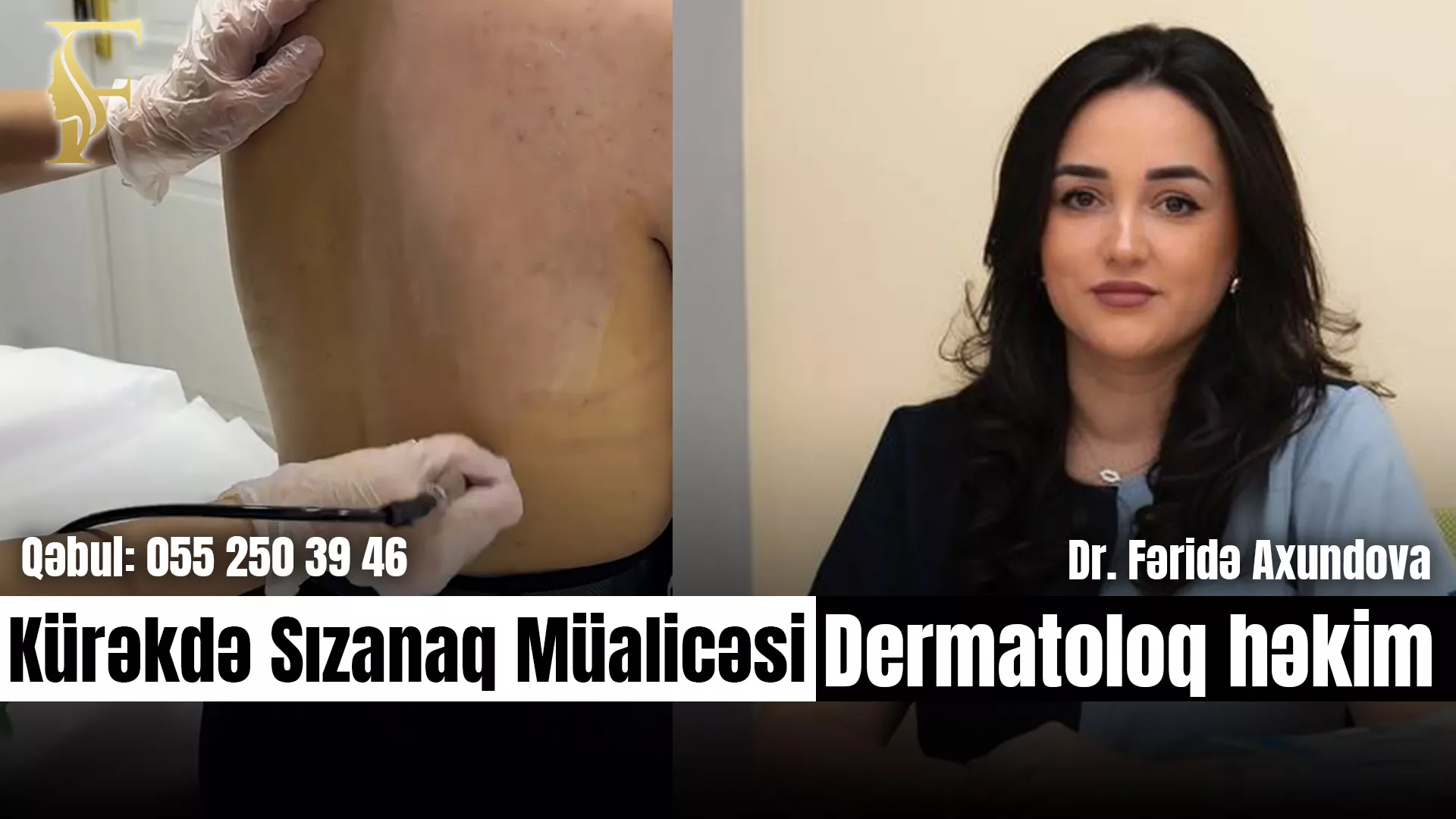 Kürəkdə Akne Müalicəsində Gedişat Necə Olur?