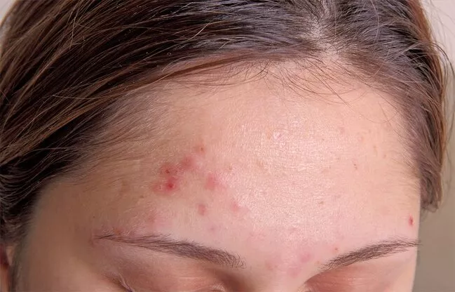 Dermatoloqla Sızanaq (Akne Vulgaris) Müalicəsi: Sağlam və Təmiz Dəriyə Necə Qovuşaq?